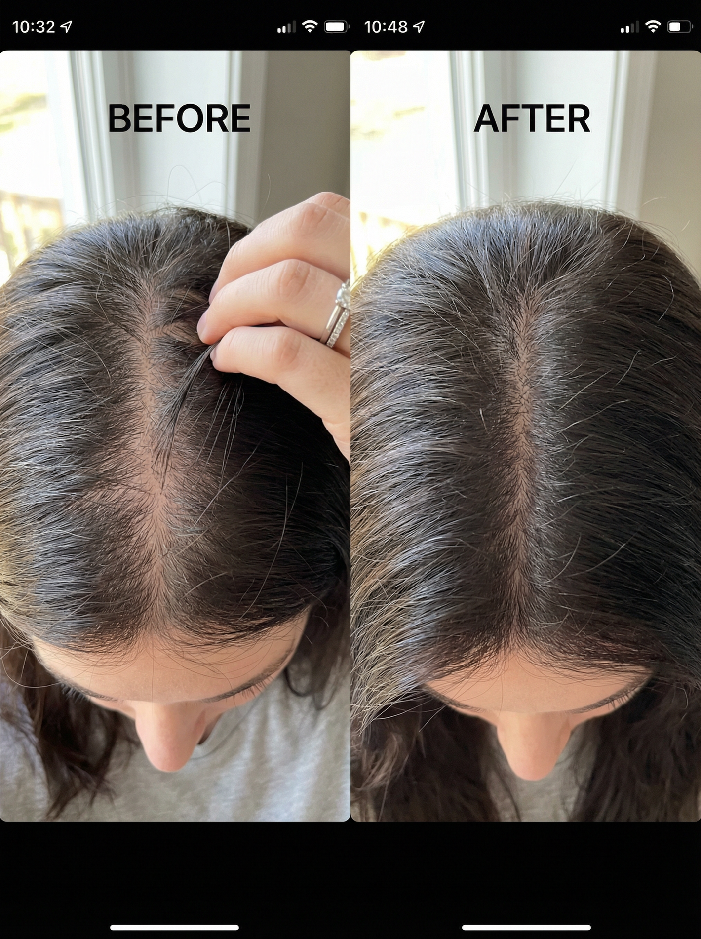 Before and after comparison of a person's hairline with a hand pointing to the difference.